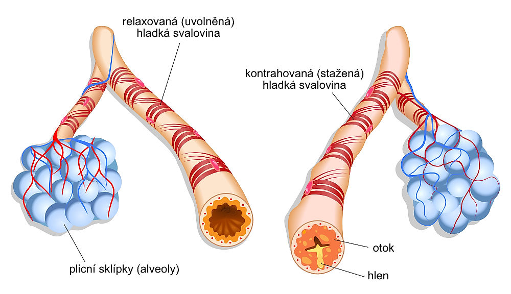 obrázek 1 k článku Astma: co to je?