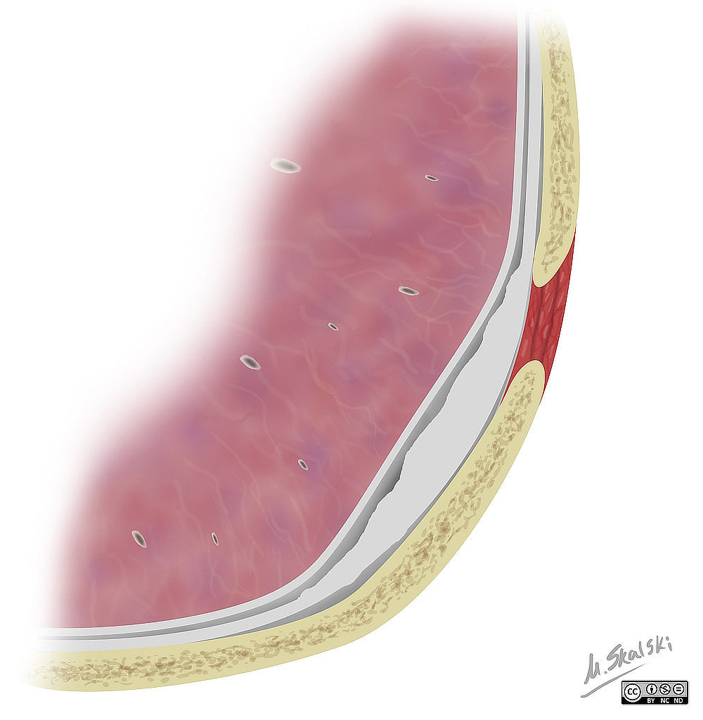 schematické znázornění pleurálních plaků