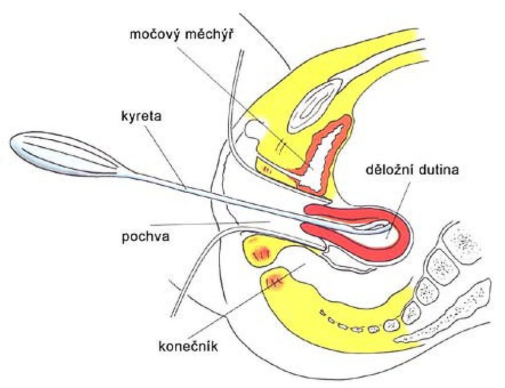 kyretáž – zjednodušené schéma zákroku