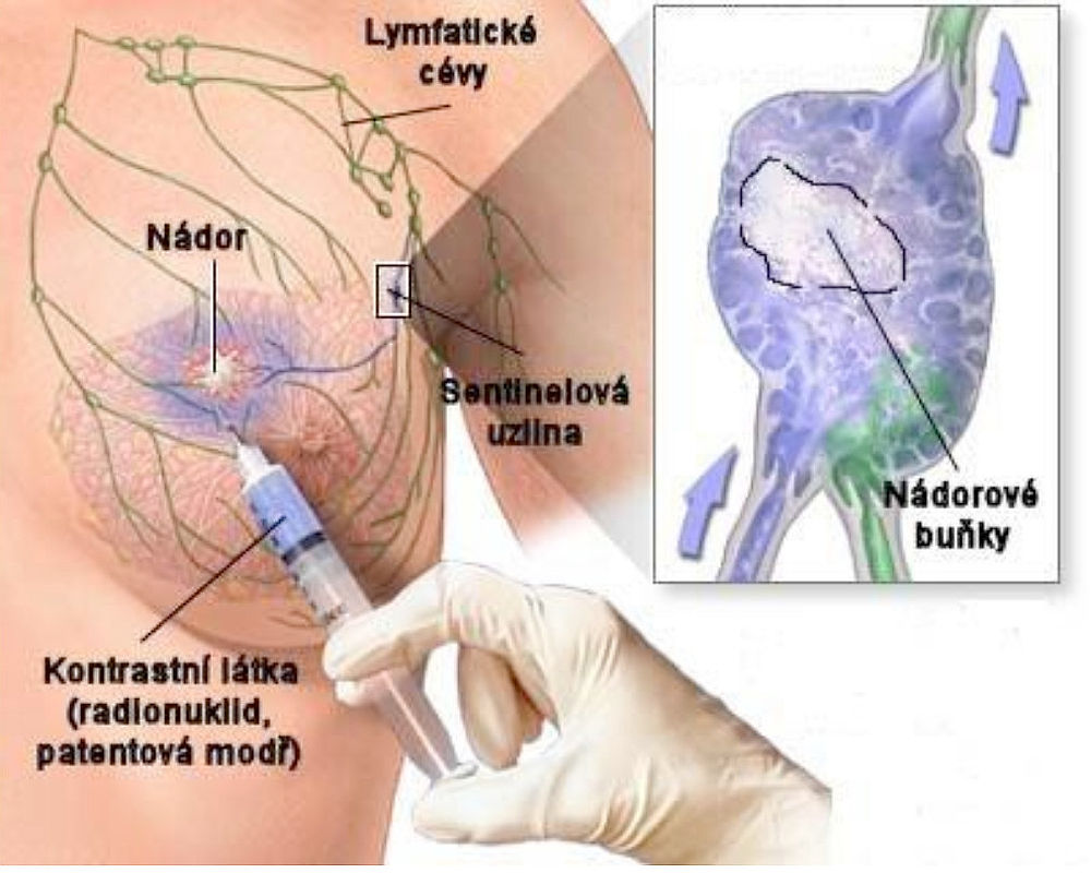 operace pro zhoubný nádor prsu – ilustrační obrázek