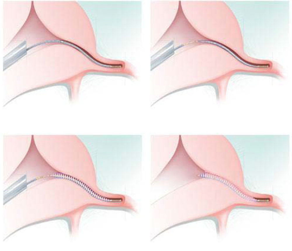 hysteroskopická sterilizace – schéma zákroku