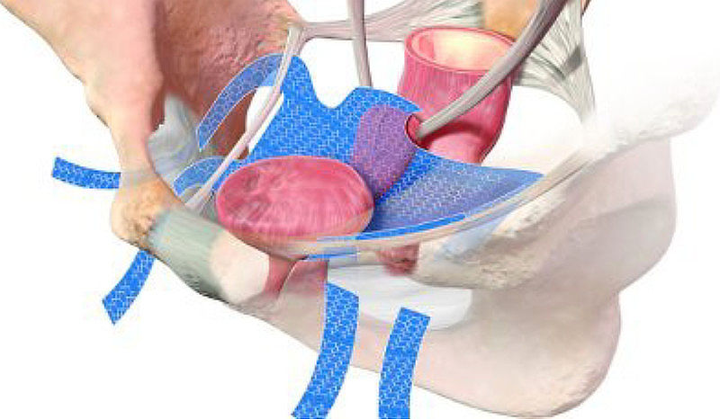 transvaginální síťka – schéma