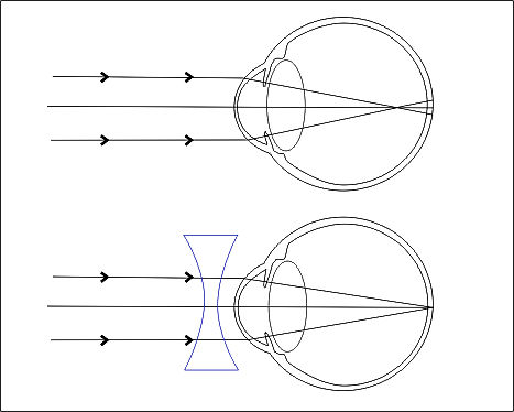 Schematické znázornění krátkozrakosti a její nápravy pomocí čočky. U krátkozrakého se paprsky světla sbíhají před sítnicí, čočka před okem upraví lomivost tak, že se paprsky sbíhají na sítnici.