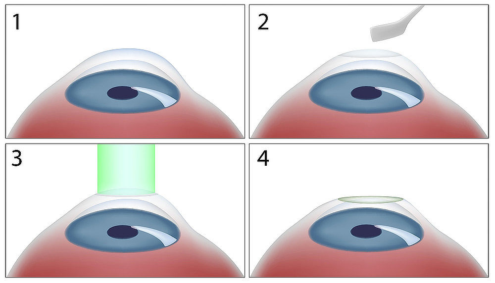 Princip fotorefrakční keratektomie (PRK)