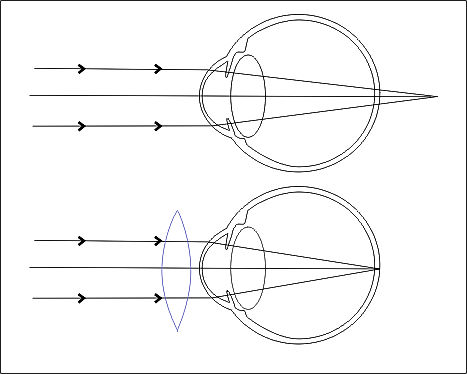 Schematické znázornění dalekozrakosti a její nápravy pomocí čočky. U dalekozrakého se paprsky světla teoreticky sbíhají až za sítnicí. Čočka před okem zajistí, že se paprsky sbíhají na sítnici.