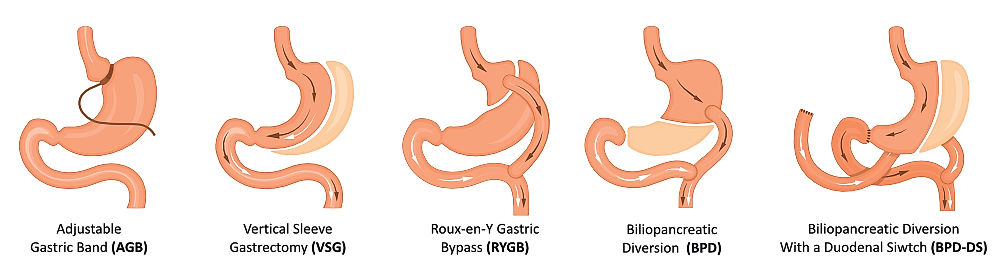 Typy bariatrických zákroků