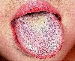 bělavý povlak jazyka v časném stadiu spály