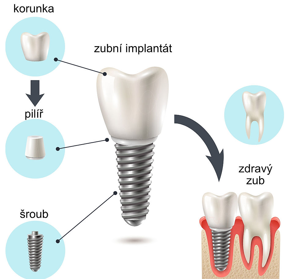 Stavba zubního implantátu. Na korunku se nasadí pilíř, do nějž se ukotví šroub, tento implantát je pak vsazen do dásně, tedy celý šroub, pilíř až po spodní část korunky umělého zubu.