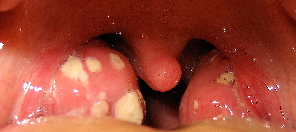 Lakunární angina. Je charakteristická přítomností hnisavých čepů - běložlutavými ostrůvky.