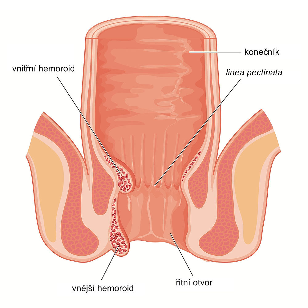 obrázek 1 k článku Hemoroidy