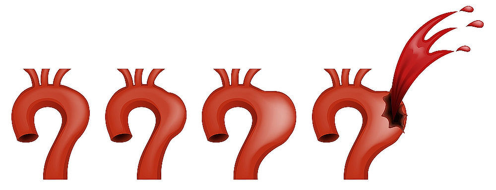 Aneurysma aorty v postupně se zhoršujícím stavu (zleva doprava) – schematický nákres. Zcela vpravo je znázorněno prasklé aneurysma, což je život ohrožující stav.