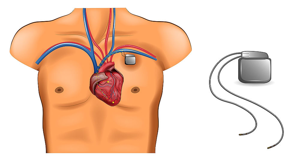 Kardiostimulátor a jeho umístění v těle – schematický nákres.